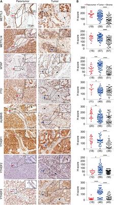 RNA m6A Demethylase ALKBH5 Protects Against Pancreatic Ductal Adenocarcinoma via Targeting Regulators of Iron Metabolism